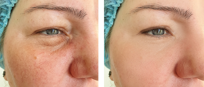 woman face before and after rosacea